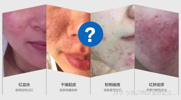 舒敏之星究竟是什么?它可以解决哪些皮肤问题? - 知乎