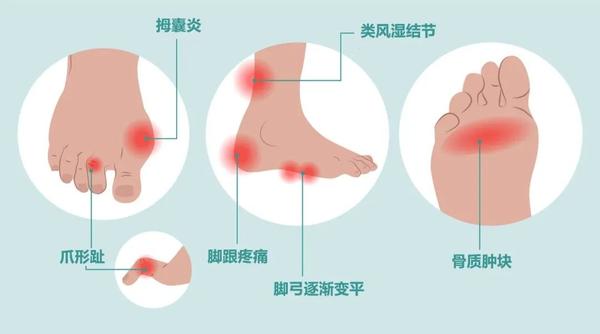 类风湿关节炎特有症状包括哪些 膝关节会受到什么影响 知乎