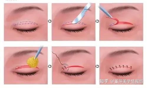 大连董萍整形三十四年:双眼皮手术真的能做到无痕吗? - 知乎