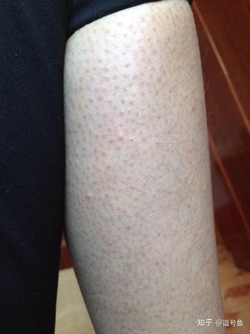 维a酸乳膏可以治疗鸡皮肤,可以明显缓解鸡皮肤引起的皮肤粗糙症状