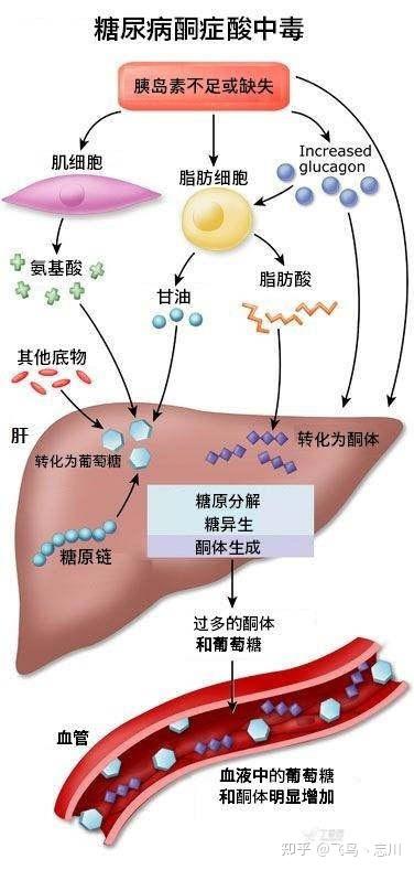 什么是糖尿病酮症酸中毒(DKA)? - 知乎