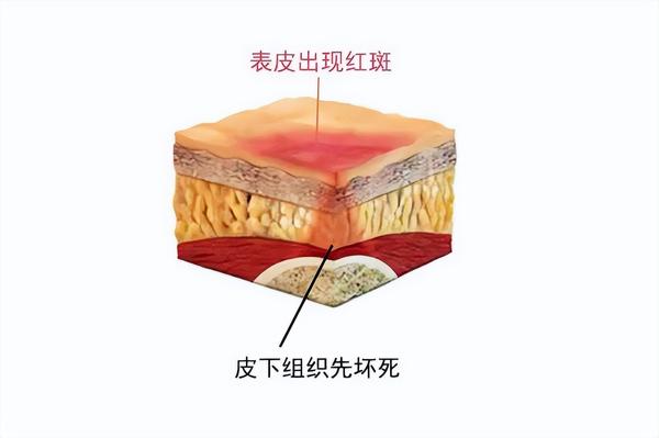 护理大讲堂 | 褥疮压疮的分期与护理方法 - 知乎