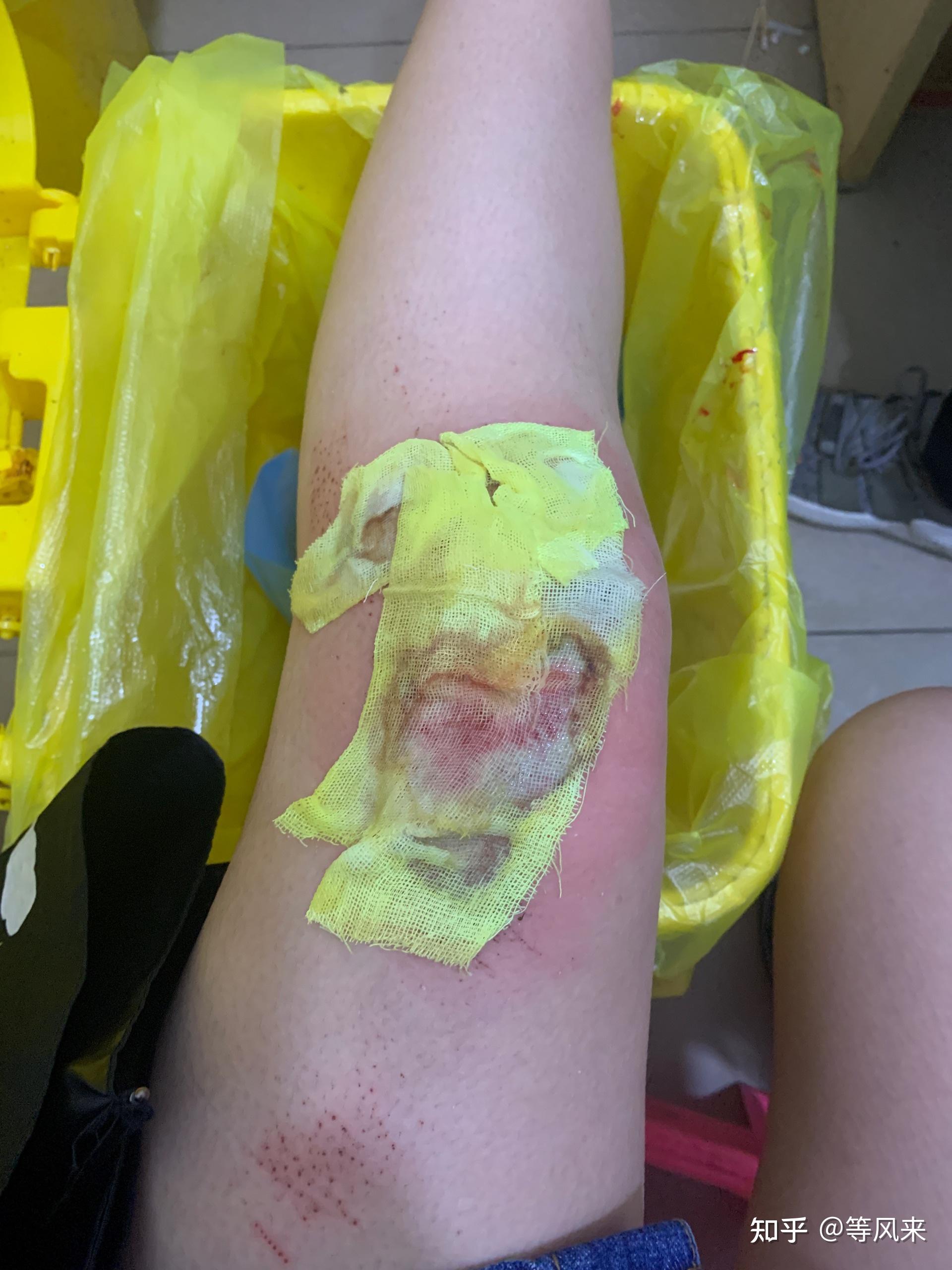 开一个膝盖腿伤恢复记录帖