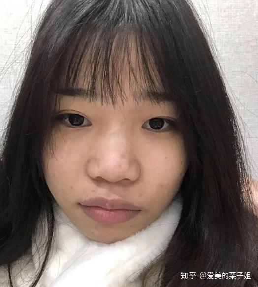 又是一个两广鼻案例,姐妹脸型和眼睛都很优秀.又 是毁在了鼻子上.