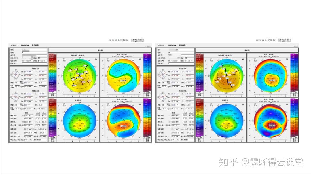 圆锥角膜的RGP验配及RGP临床效果分析（文字版） - 知乎