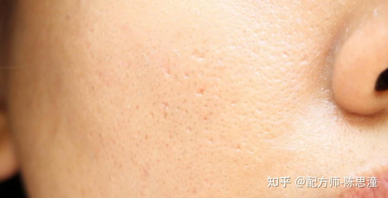「毛孔粗大」可以“缩”回去吗? - 知乎