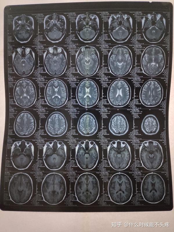 脑血管痉挛偏头痛血管性头痛神经性头痛我到底该怎么办