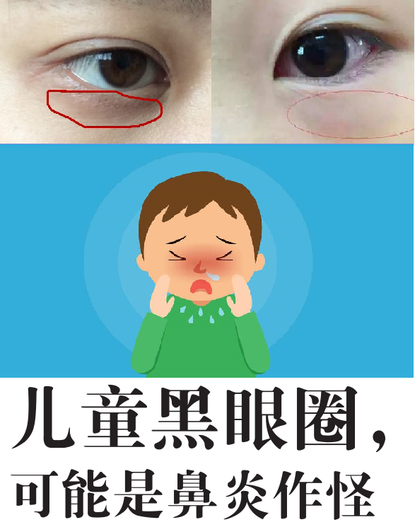 熊猫眼怎么治疗图片