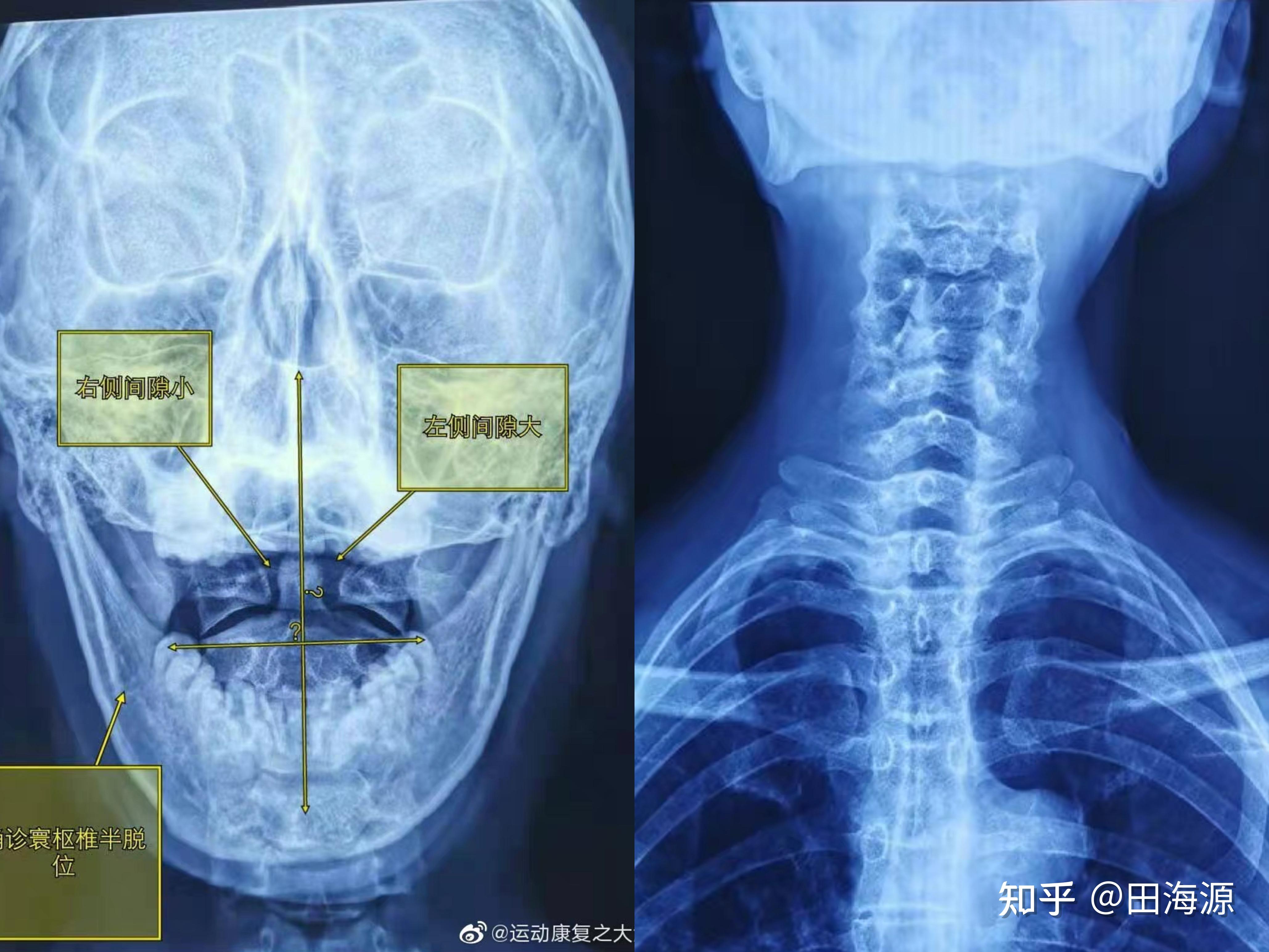 儿童寰枢椎不对称图图片