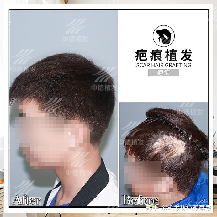 中德植发记录:疤痕植发抚平伤痕,蜕变新人生! - 知乎