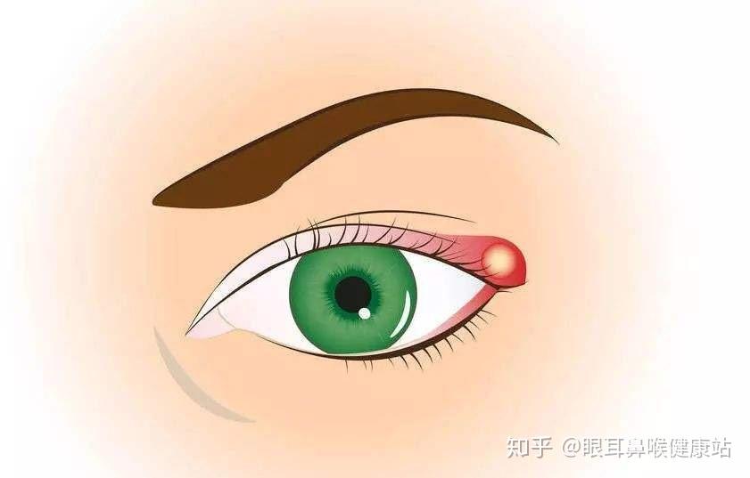 北京首大宋立为您讲解：针眼都有哪些病因？针眼的常见症状有哪些？ - 知乎