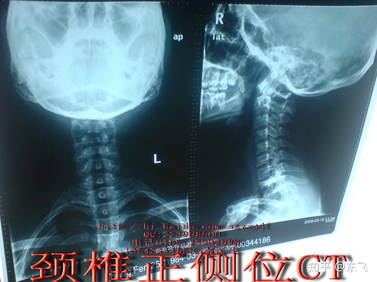 正常人颈椎x光片,正常人颈椎骨图片,正常人颈椎_大山谷图库