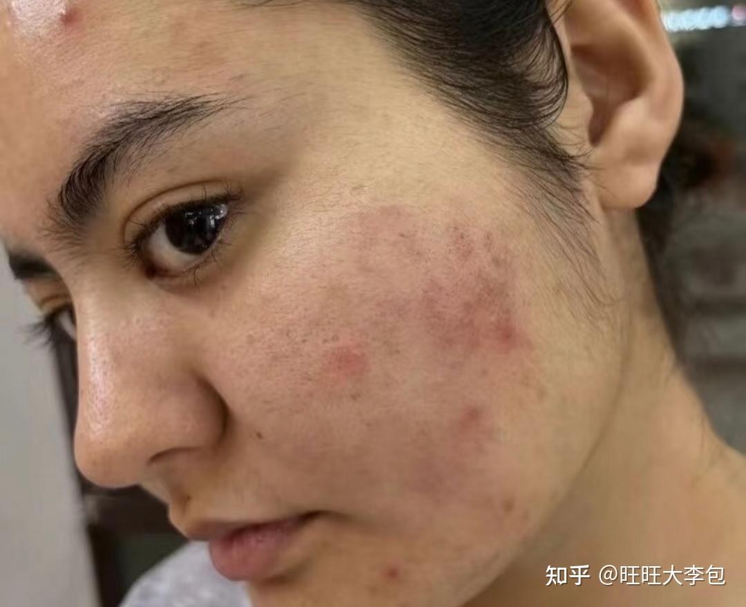 用针把痘痘弄破,会好吗? - 知乎