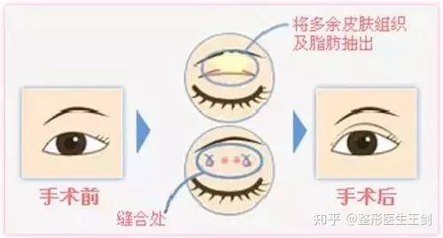 眼整形专栏 眼部重睑术五要素 知乎