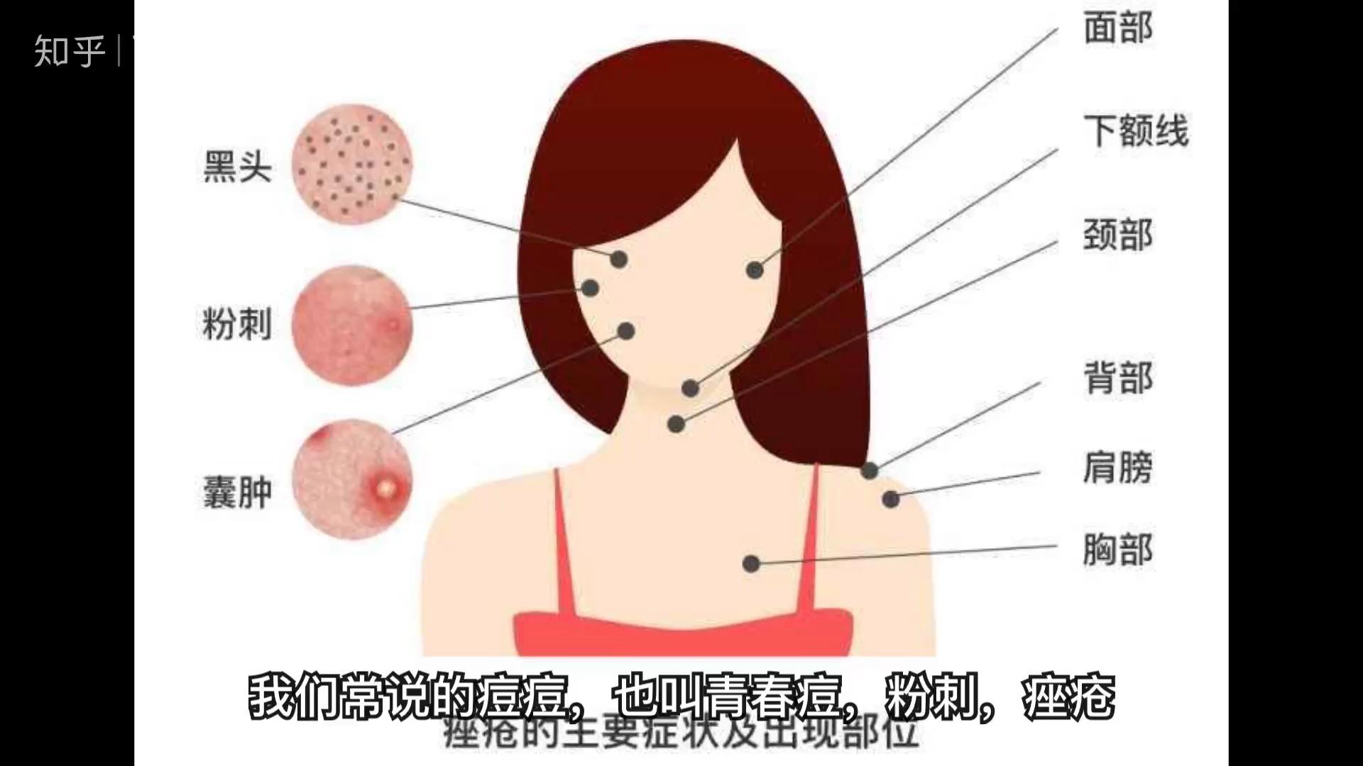 2:32腮帮子长痘痘是怎么回事?