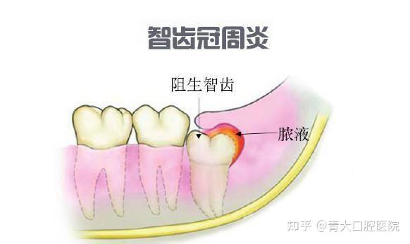 青岛青大口腔医院告诉您：什么是智齿冠周炎 - 知乎
