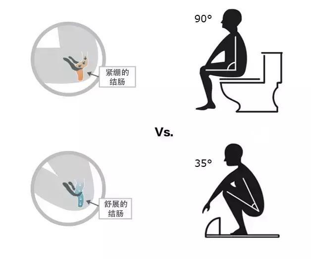 上厕所的正确姿势 哪一种更有利于排便 知乎 上厕所的正确姿势 哪一种更有利于排便 知乎