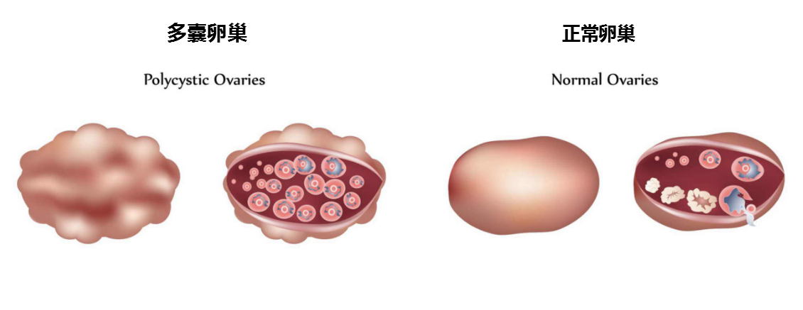 多囊自愈多囊卵巢多囊卵巢綜合徵我就可以不管它了錯