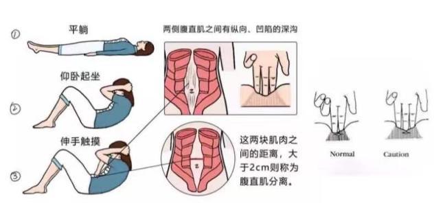 如何判断自己是否有腹直肌分离的情况?