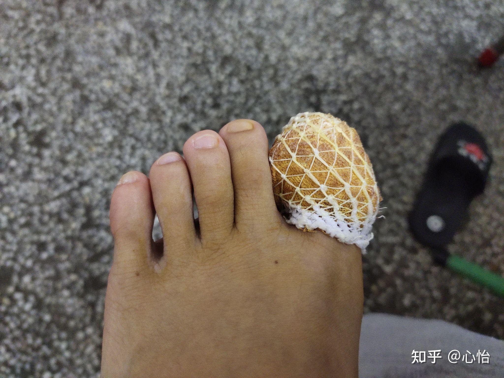 拔大拇指脚指甲 - 知乎