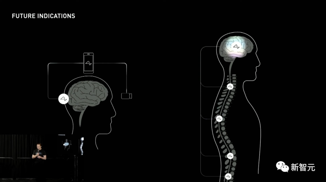 电极插好，马斯克给你切脑！Neuralink临床实验获FDA批准，脑机接口计划到达新里程碑 - 知乎