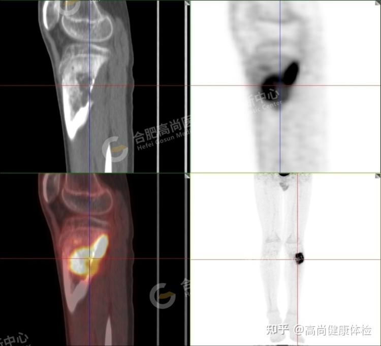 自我判断骨肉瘤图片