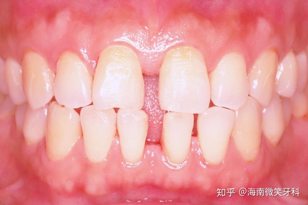 牙缝大的主流修复方式牙齿贴面