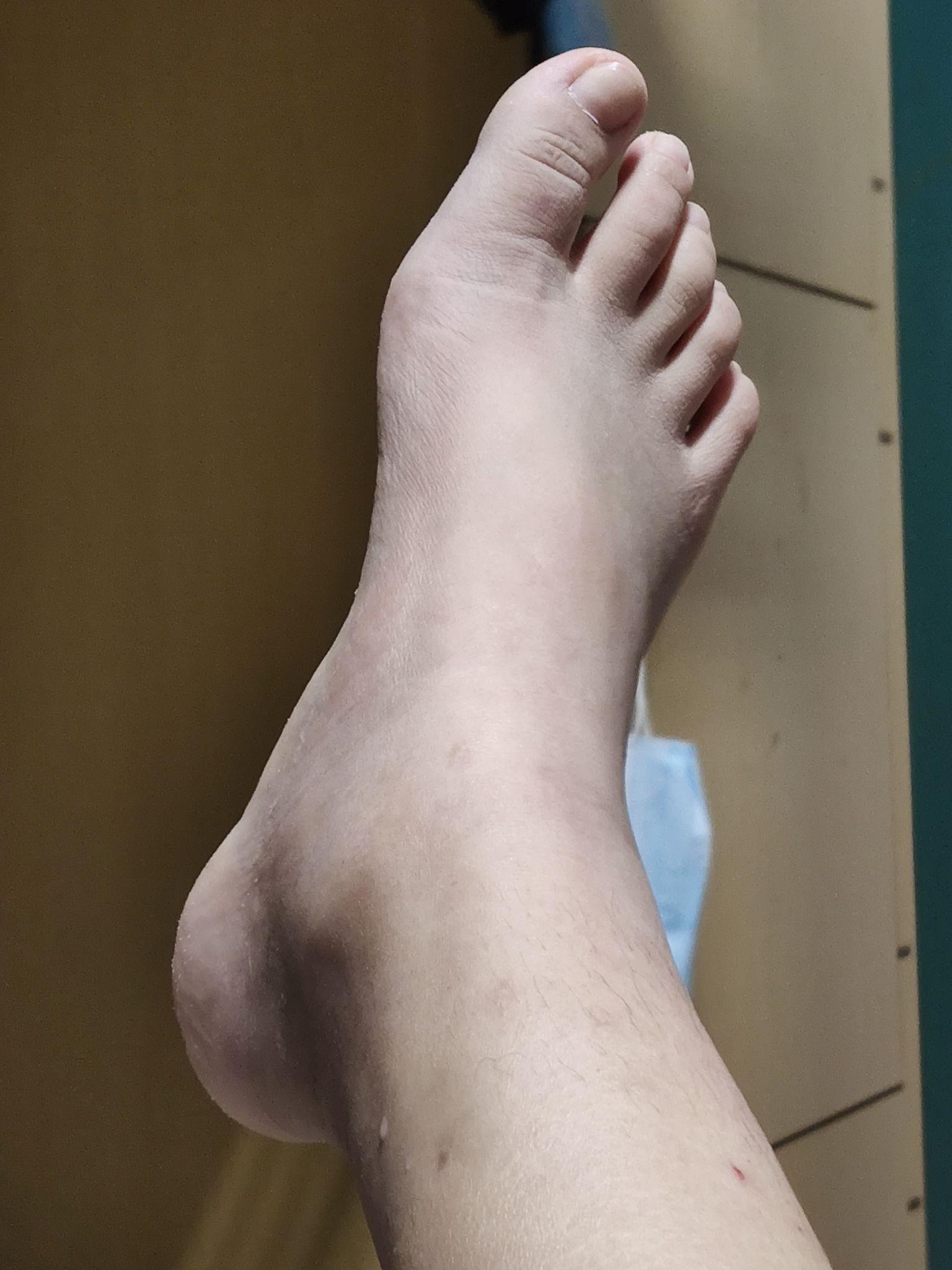 脚踝韧带损伤距骨挫伤日记