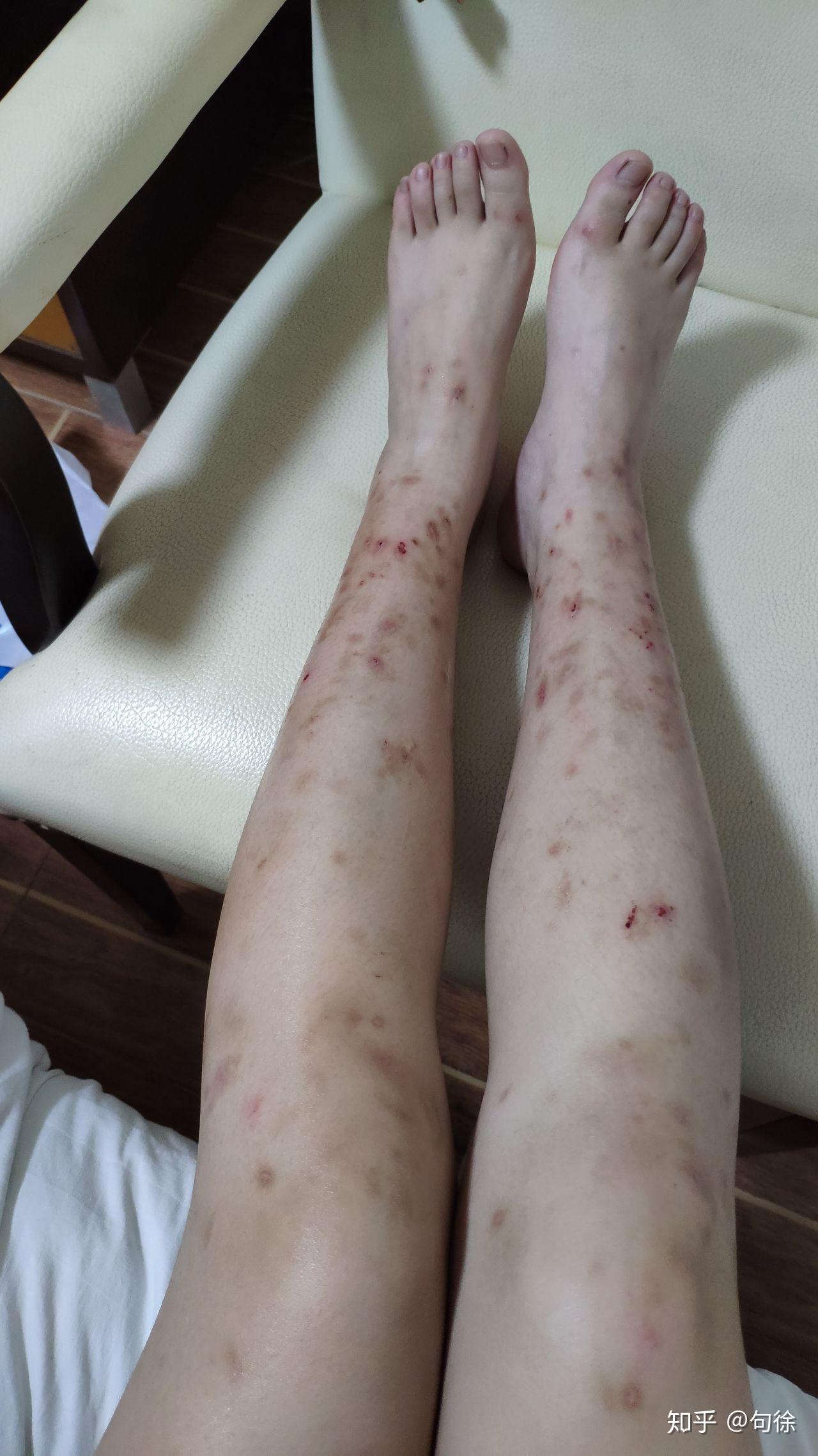 被蚊子咬了留下的疤怎么去除