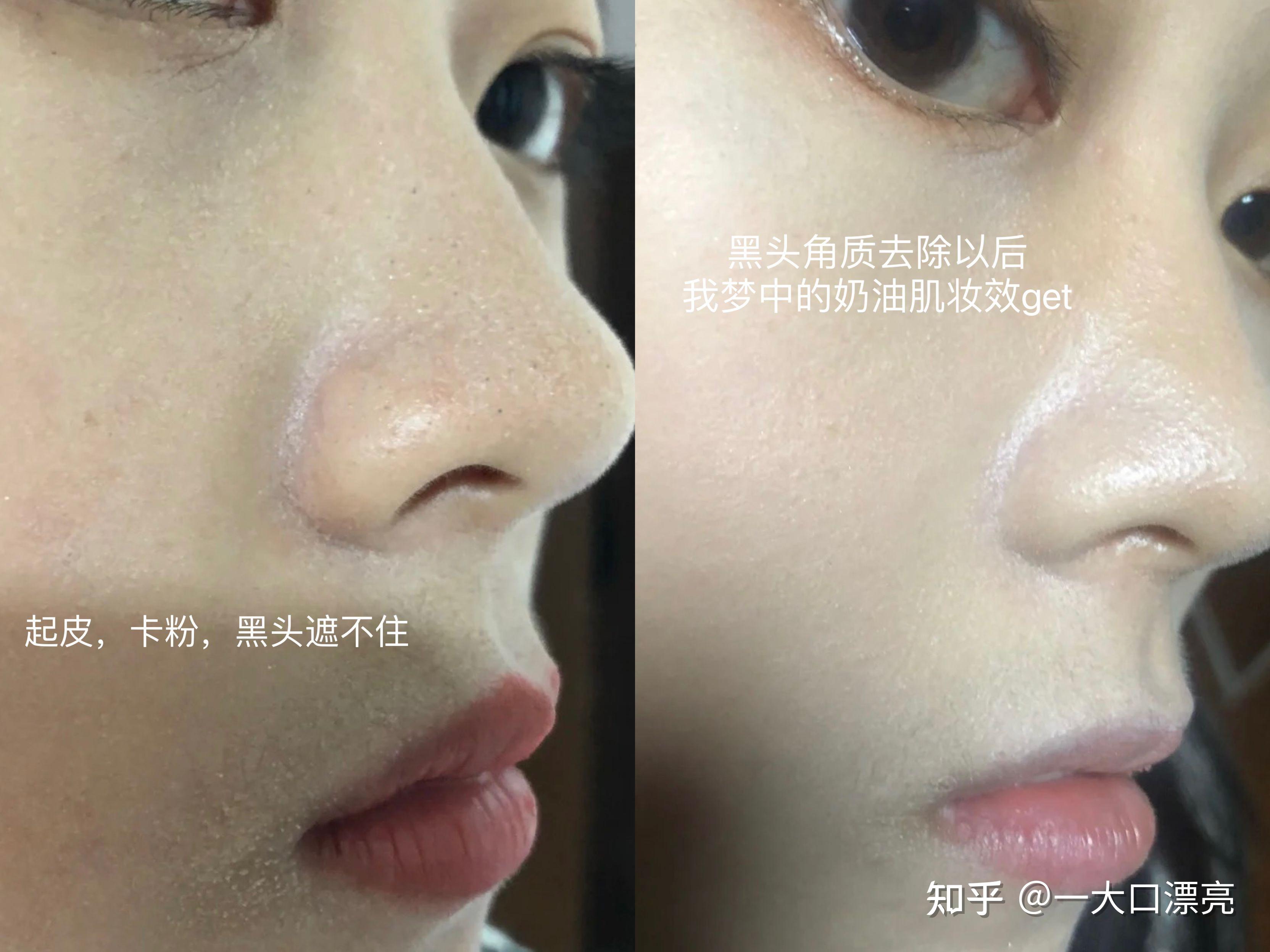 毛戈平化妆学校去黑头是真有一套，几分钟就能把黑头揉净，自己在家也能搞 - 知乎