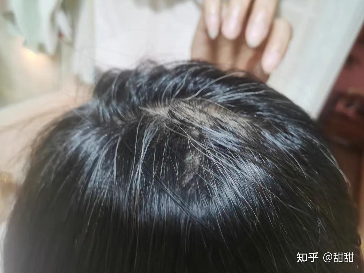 禿头逆袭了 - 知乎