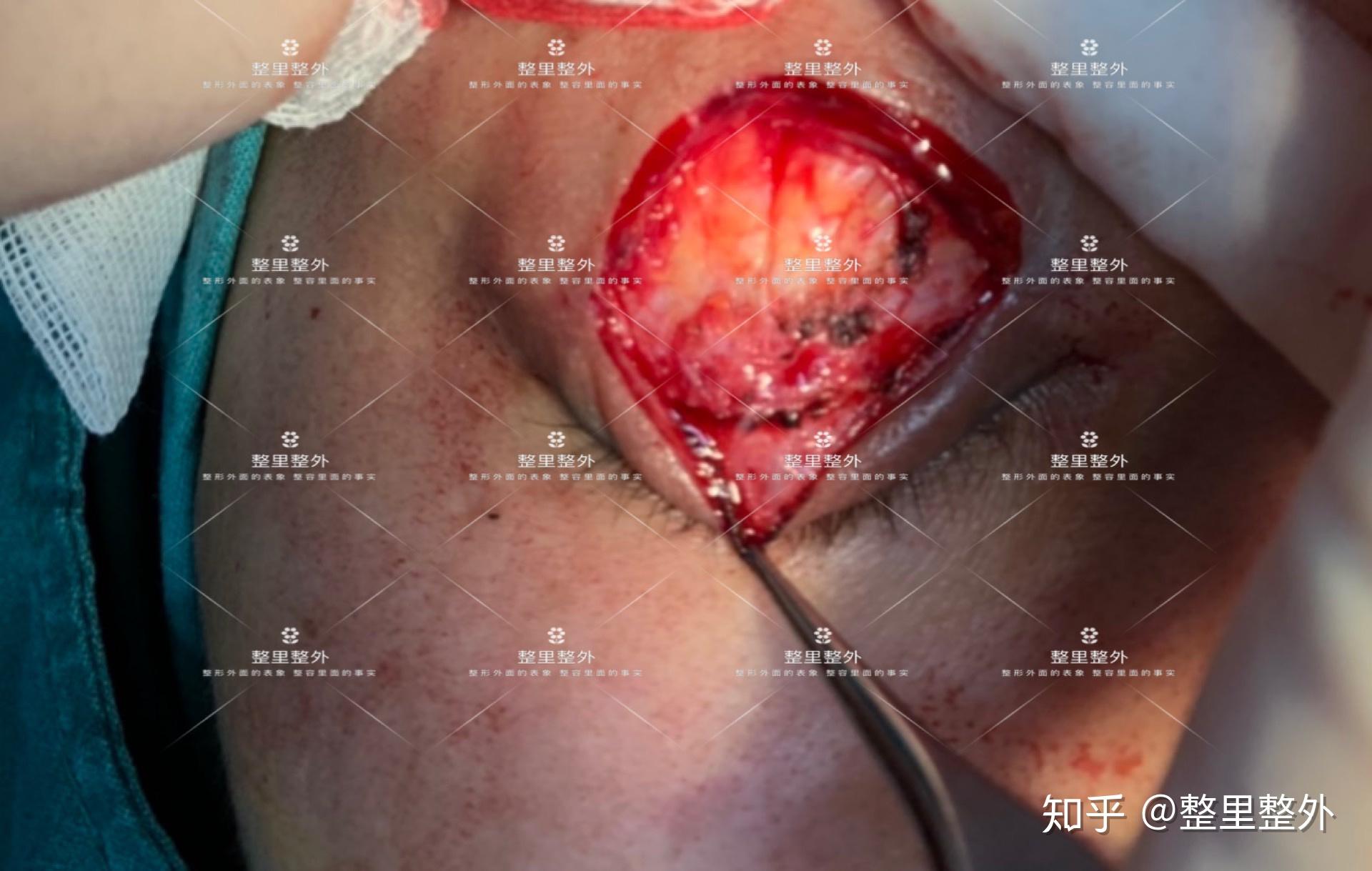 做完双眼皮手术眼睛居然下垂了