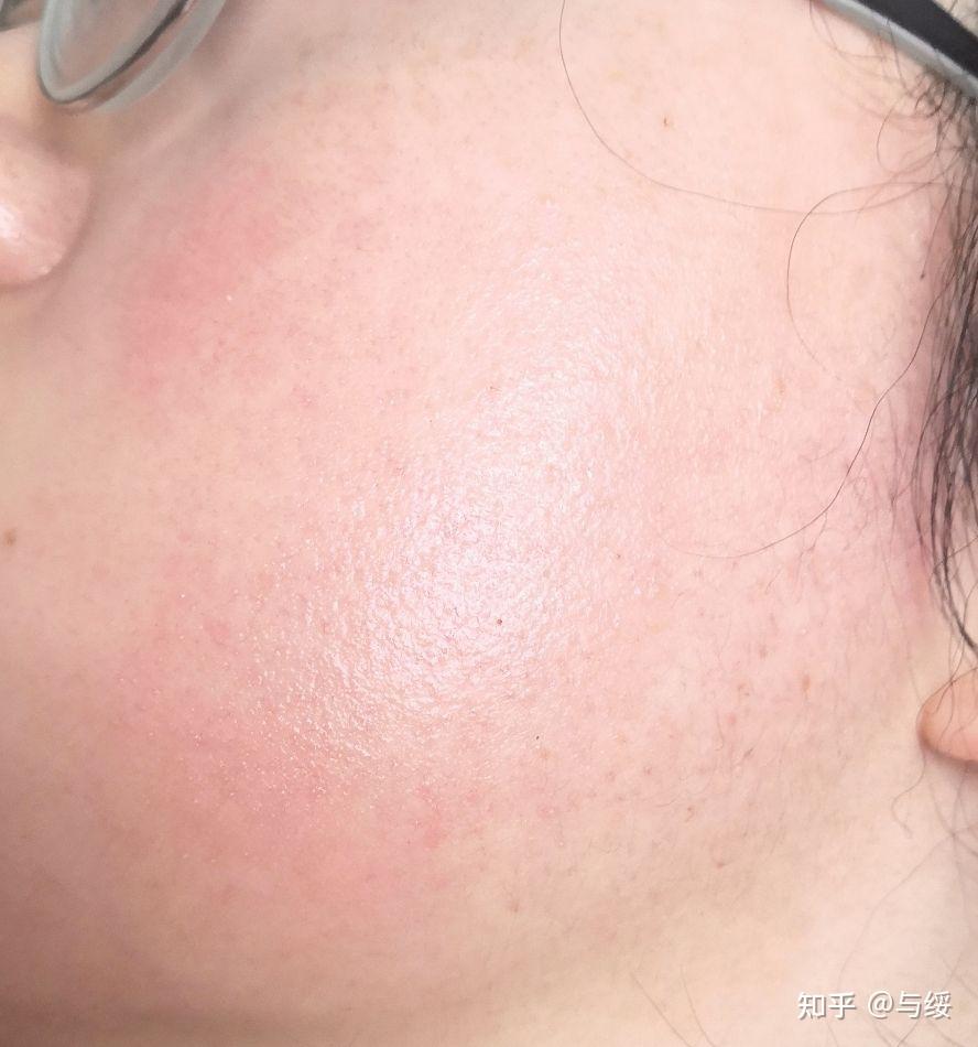 光子嫩肤经验贴 (主要目的:去红血丝) - 知乎