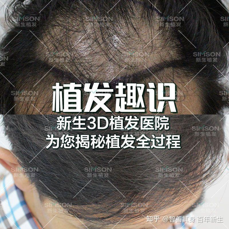 3d植发揭秘过程