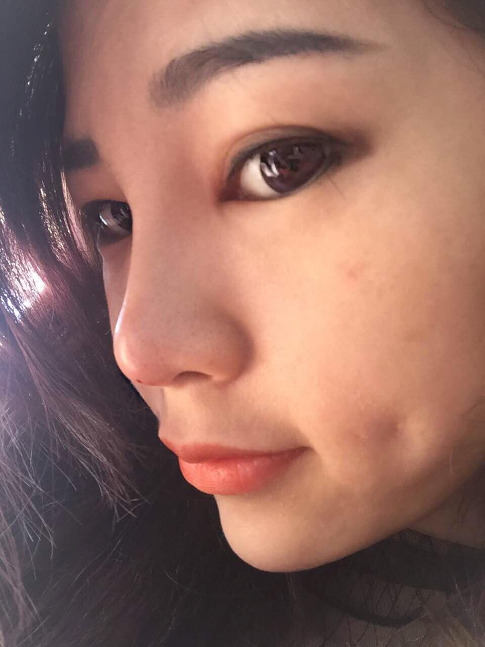 哈哈……这是第二天肿了的样子,鼻子已经结痂了哈哈……头也懒得梳了