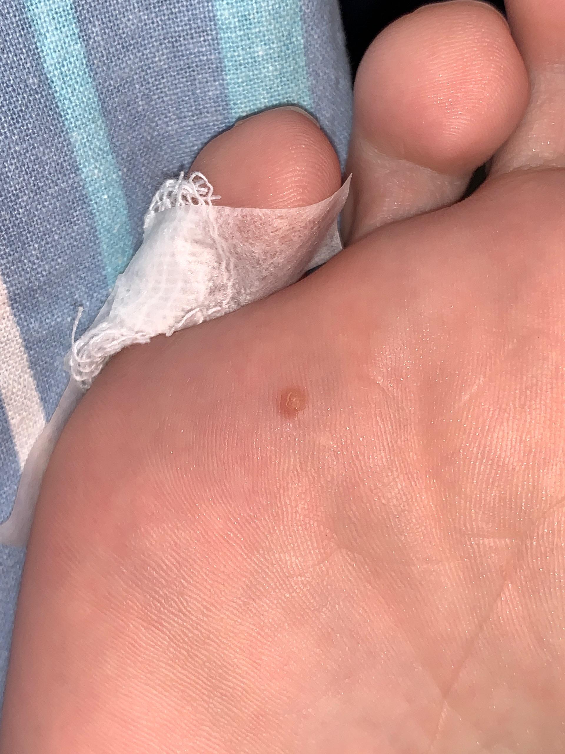 冷冻跖疣过程记录