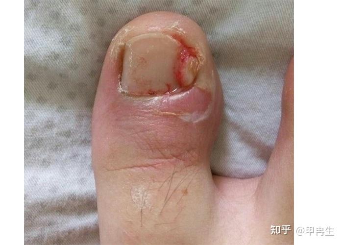 指甲周围的软组织发生了感染,而导致的发炎就是甲沟炎