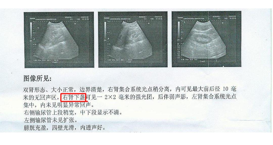 这个简单有效的肾结石排石方法你可能还不知道