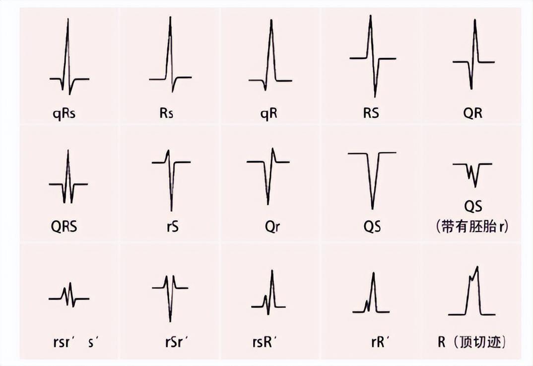 正常心电图由几种不同波形组成,各自代表每个心动周期心脏不同部位的