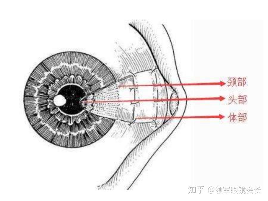 翼狀胬肉是什麼鬼