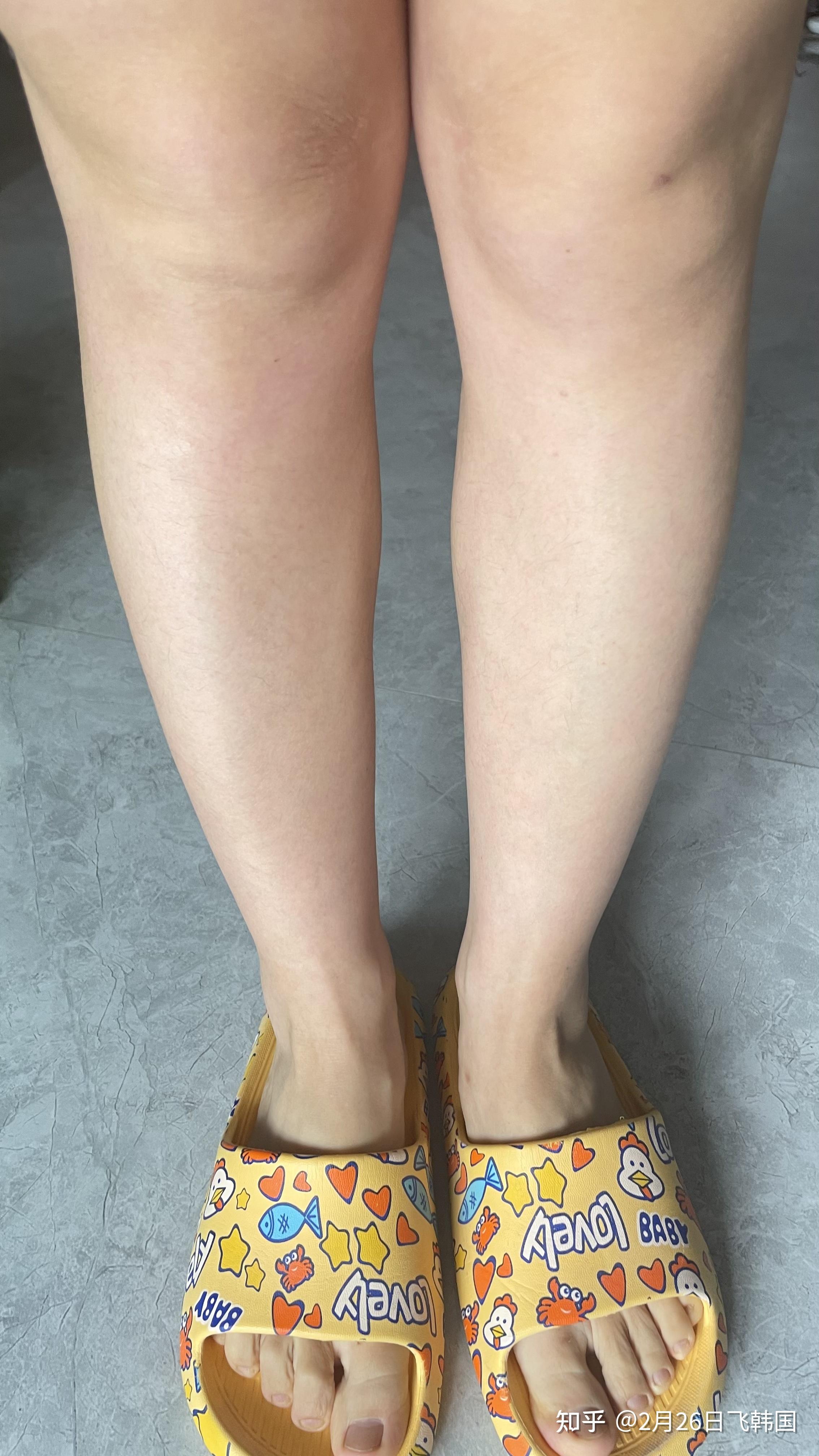 小腿围36厘米的姑娘打瘦腿针全过程