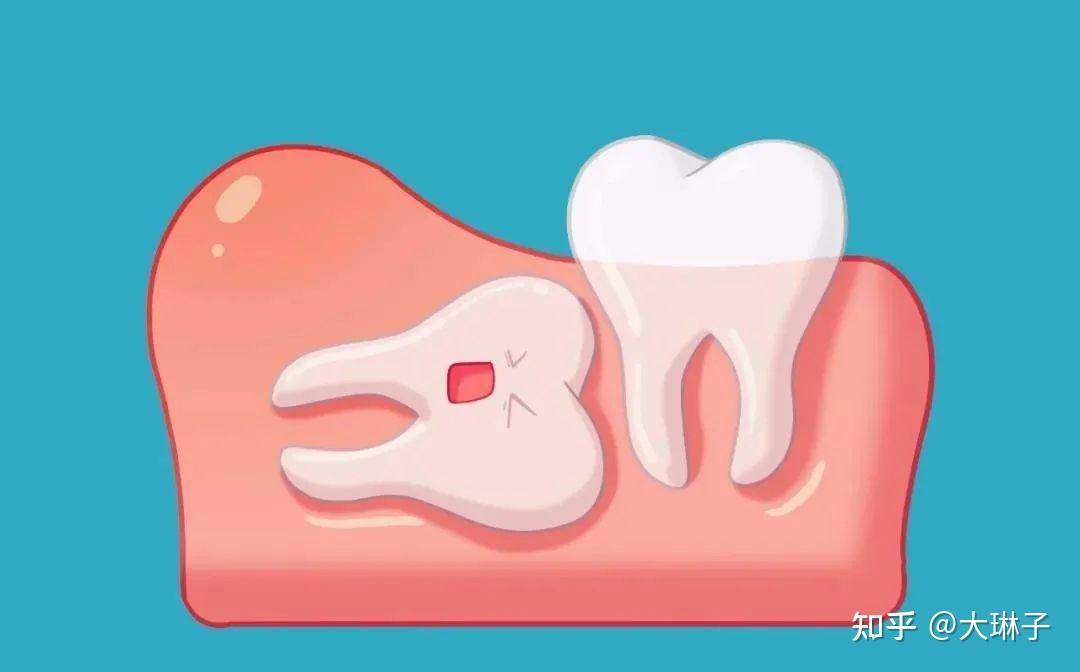 什麼樣的智齒要拔掉