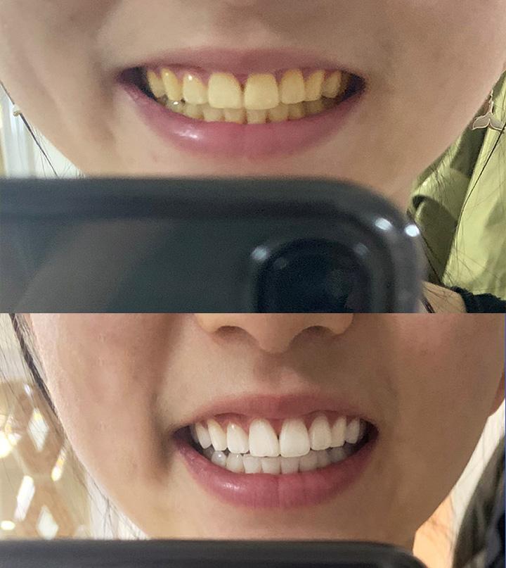 牙粉真的能美白牙齿吗?真的有效果?