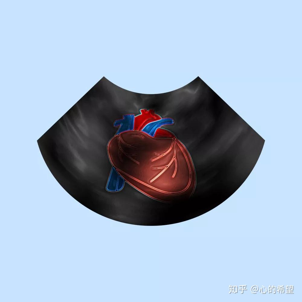 心脏三尖瓣反流 zhuanlan.zhihu.com