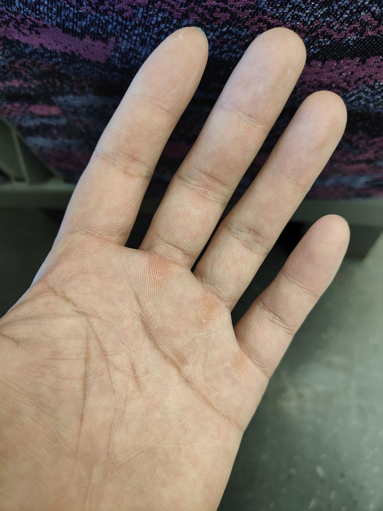 头汗症影响了20年,终于治好了.