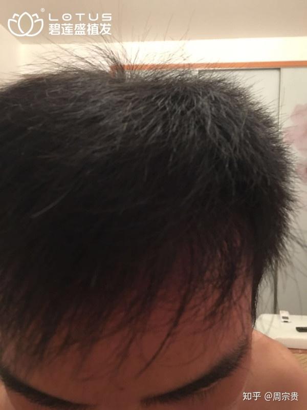 从额角开始的脱发,为什么那么难发现? - 知乎