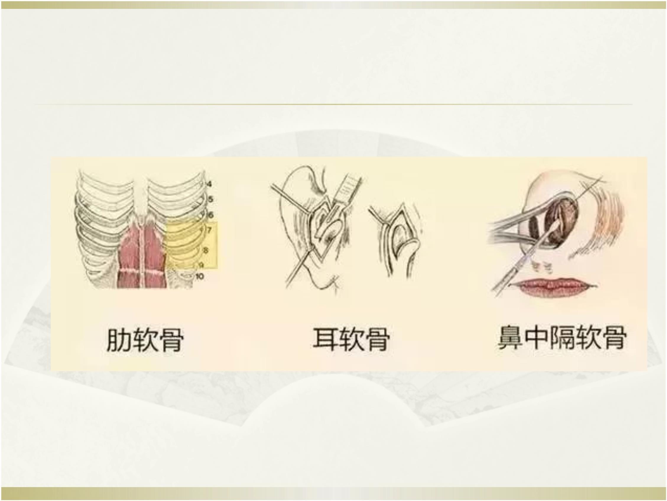 如若不合适则取出假体重新雕刻后再置入剥离腔隙:鼻背筋膜与鼻骨骨膜