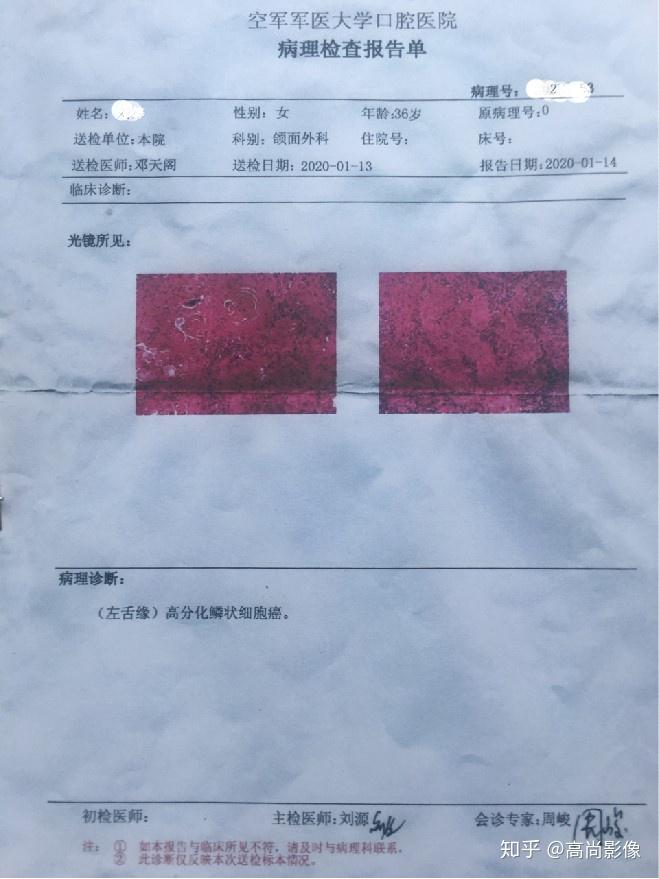 西安高尚医学影像诊断中心病例口腔鳞状细胞癌2例