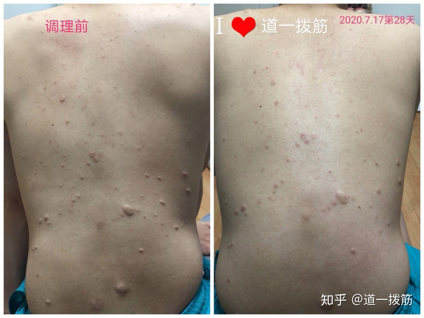 神经纤维瘤调理实时报道3杨先生