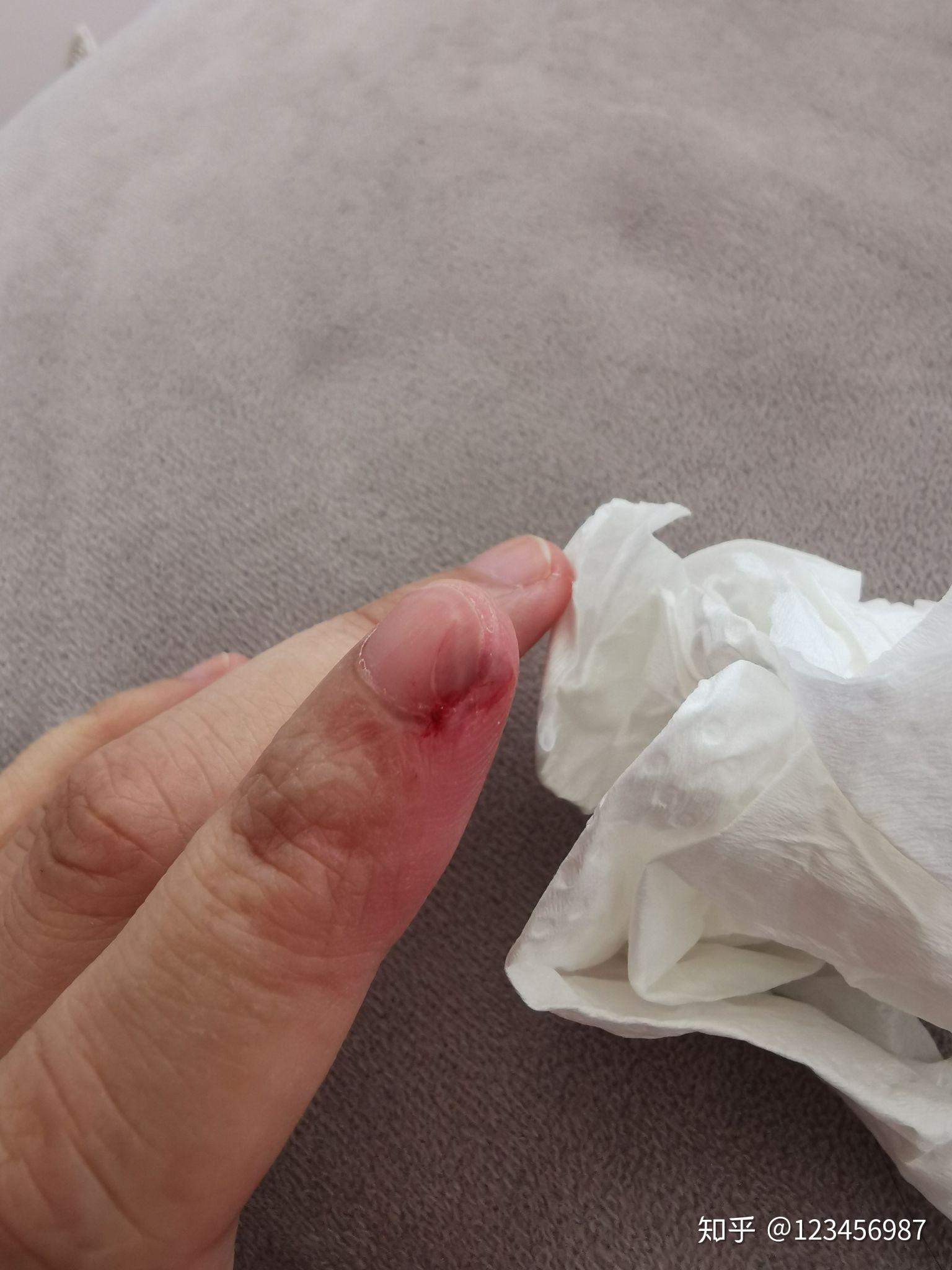 切菜的时候把手指甲切掉了一半血流不止英国的医生只用温水冲了一下就